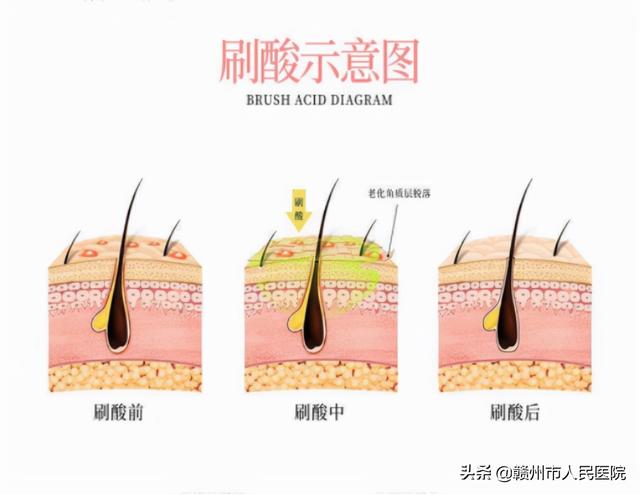 什么是刷酸 刷酸有什么用，什么是刷酸（科普：美女们都在说刷酸）