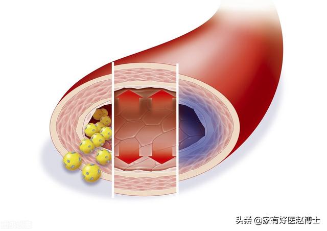 脉搏波传导速度，什么叫做脉搏波速度PWV（“血管老化”的五大常见征象）