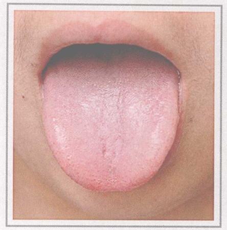 舌淡苔白滑的症状及预示的疾病类型,舌淡苔白滑是什么意思(怎样通过