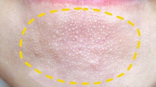 脂肪粒是什么样子，脂肪粒是什么样的（都有“颗粒感”）