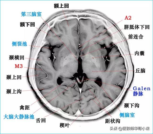 头颅ct解剖图，头部骨骼结构图（颅脑磁共振MRI解剖结构以及高清图谱）