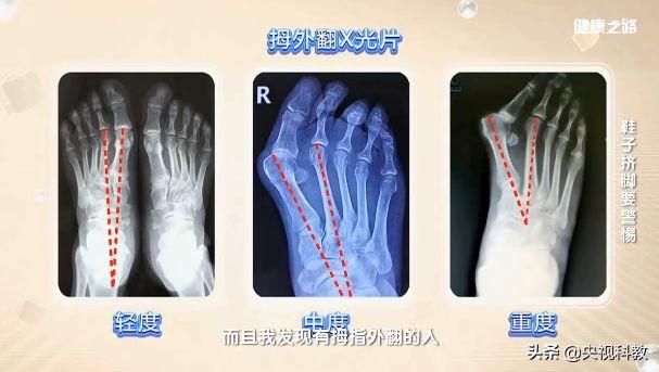 小拇指外翻怎么矫正，让你又丑又疼的拇外翻矫正方法在这里