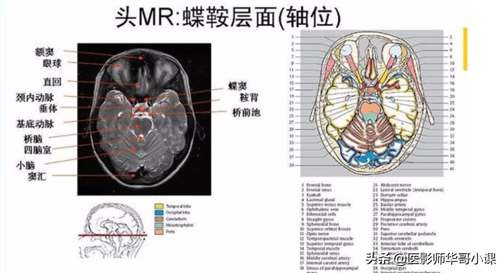 颅脑mri(头部MRI)插图(76)