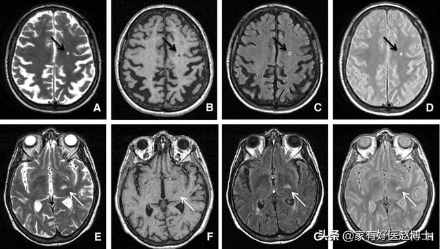 脉搏波传导速度，什么叫做脉搏波速度PWV（“血管老化”的五大常见征象）