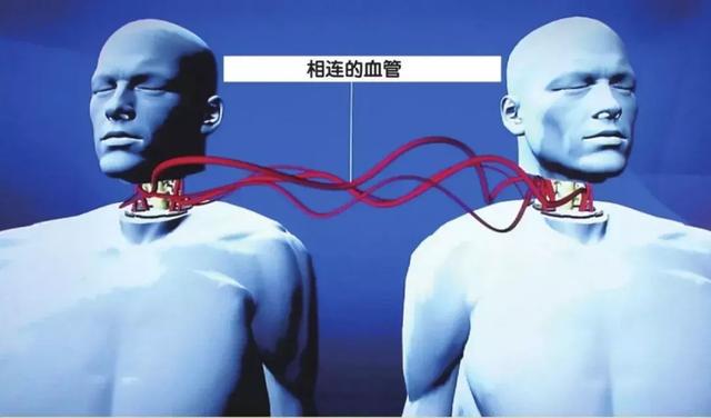  世界上第一位换头手术，捷报：人类首例换头手术成功 