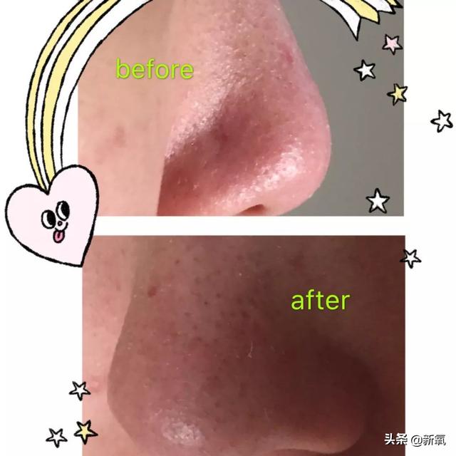 怎么去黑头小窍门，五个去黑头方法（我把火爆全网的去黑头方法试了一遍）