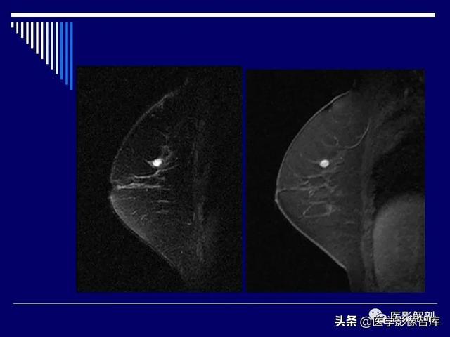 乳房解剖学基础知识，乳腺解剖及乳腺各病变影像诊断与鉴别