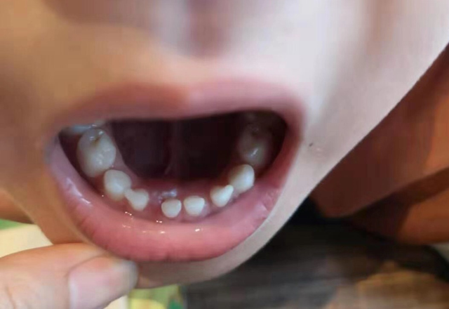 6岁儿童下排门牙内侧长出牙，6岁下门牙还没掉就长新牙（6岁男孩乳牙没掉就冒出恒牙）