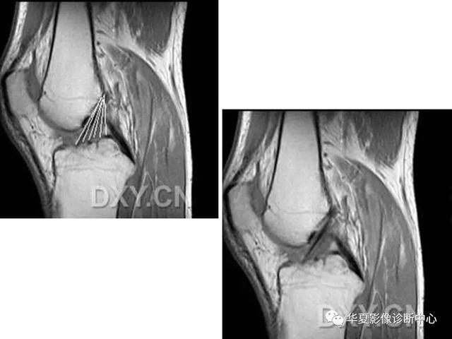 膝关节解剖结构图，膝盖解剖图示意图（膝关节MRI之正常解剖综述）