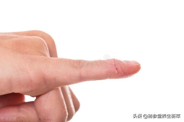 甲沟炎和甲下脓肿怎么治疗，甲沟炎和甲下脓肿怎么治疗好（甲沟炎有脓怎么排脓）