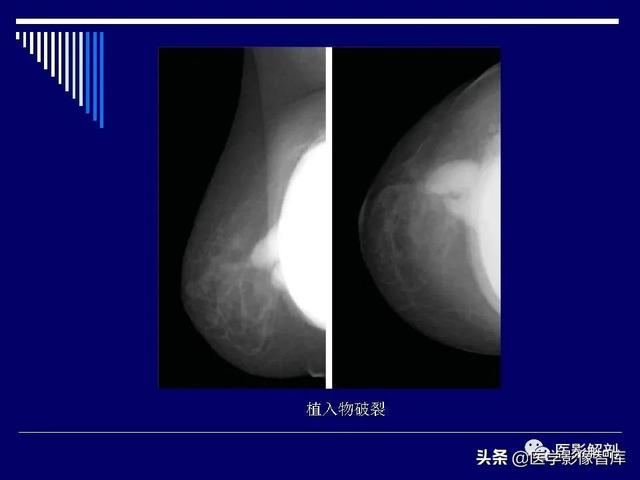 乳房解剖学基础知识，乳腺解剖及乳腺各病变影像诊断与鉴别