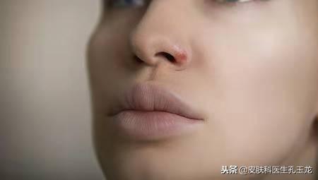 嘴唇上长疱疹图片，嘴唇长疱疹怎么治疗（嘴唇上火的真相——单纯疱疹）