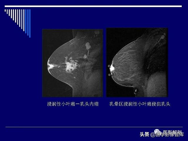 乳房解剖学基础知识，乳腺解剖及乳腺各病变影像诊断与鉴别