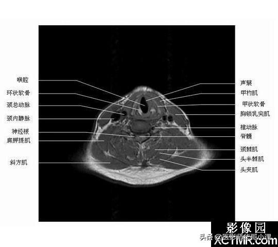 颅脑mri(头部MRI)插图(55)