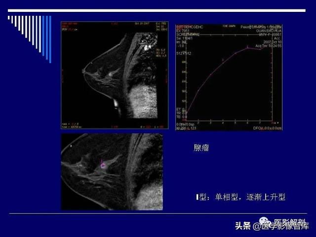 乳房解剖学基础知识，乳腺解剖及乳腺各病变影像诊断与鉴别