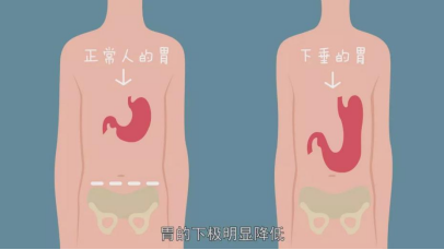 重度胃下垂怎么治疗，重度胃下垂有什么症状（胃下垂？教你如何6步治愈法）