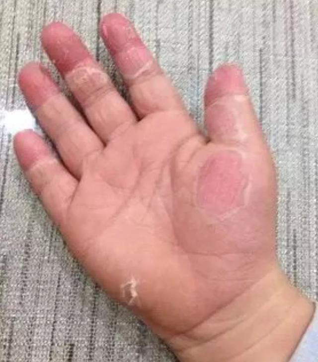 小孩手脱皮补充什么维生素,小孩手脱皮是缺什么(家长给宝宝狂补维生素