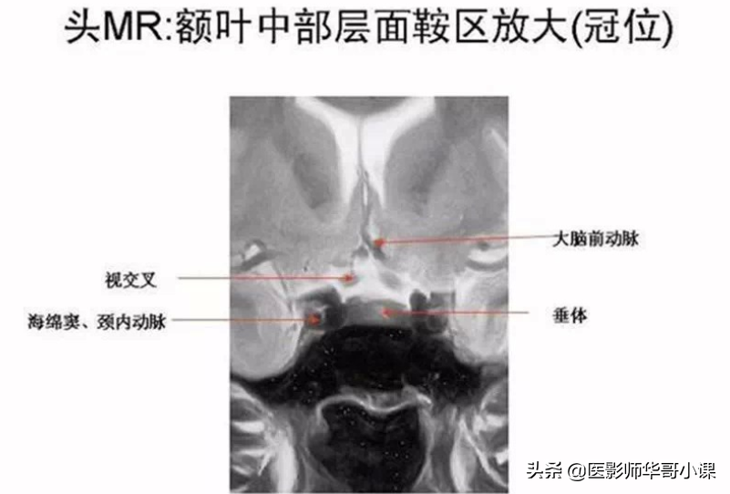 颅脑mri(头部MRI)插图(62)