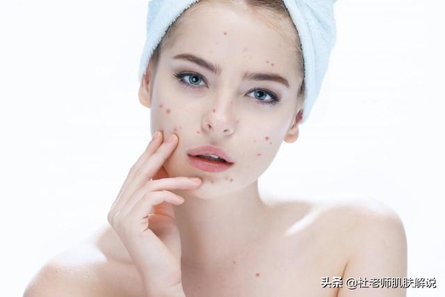 t字区长痘因为什么，t字区长痘什么原因（脸上不同位置长痘痘是什么原因）