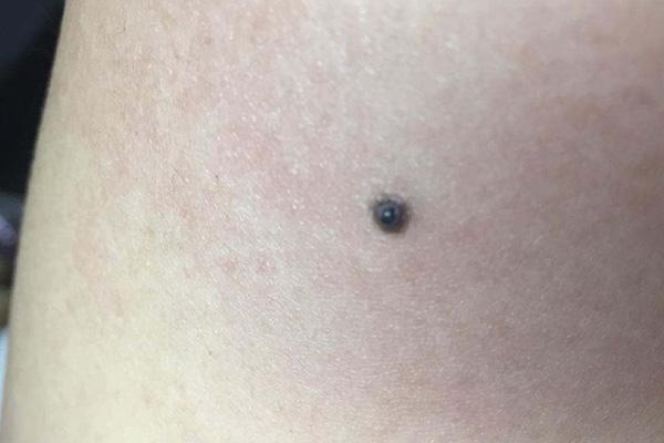 苦情痣是什么意思，苦情痣是什么意思呢（是老人说的“苦情痣”）