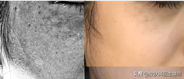 手臂上有咖啡色的斑图片，为何手臂上有很多暗沉的色斑（一文教你辨识自己长的究竟是啥斑）