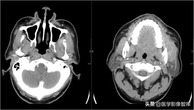 颞间隙感染，颞间隙感染切开部位（颌面部间隙感染影像诊断及各间隙解剖介绍）