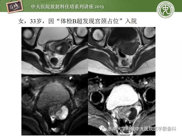 子宫颈影像解剖，子宫详细解剖及磁共振信号分析