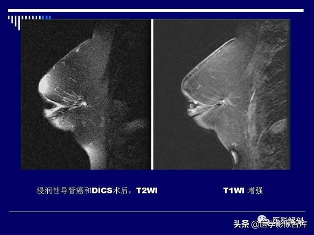 乳房解剖学基础知识，乳腺解剖及乳腺各病变影像诊断与鉴别