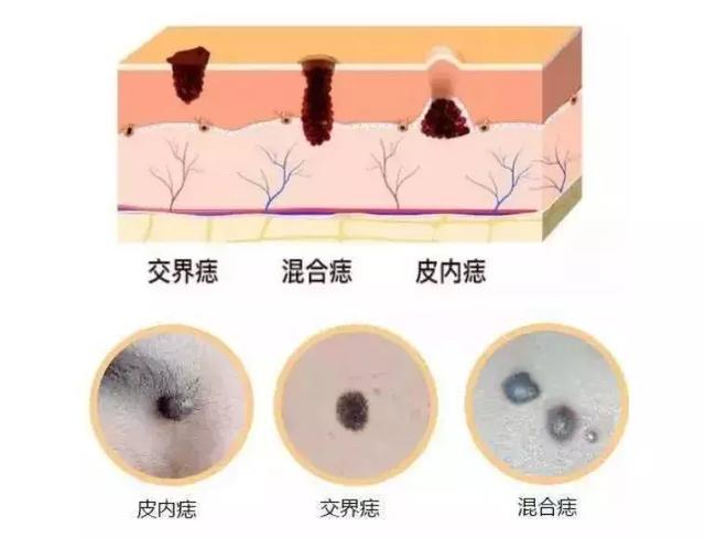 去痣有哪些，去痣有哪些方法（揭秘各类点痣大法）
