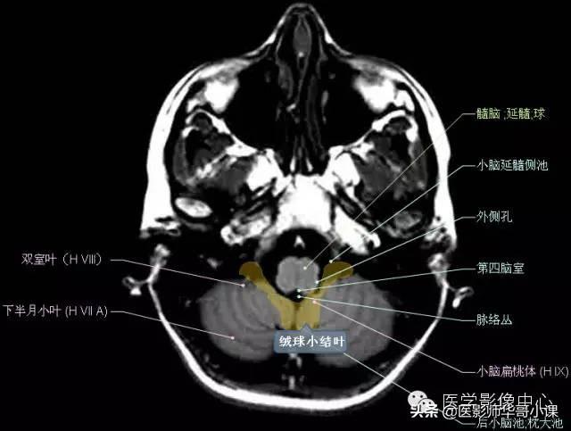 颅脑mri(头部MRI)插图(39)