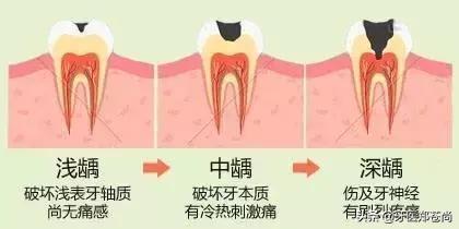 牙烂到什么程度要根管治疗，牙烂到什么程度要根管治疗儿童（蛀牙烂到神经，就要做根管治疗）