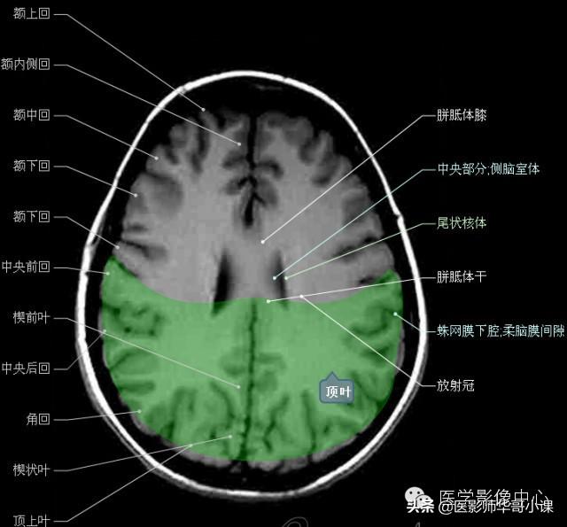 颅脑mri(头部MRI)插图(28)