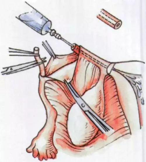 结扎了做复通手术需要多少钱,输卵管结扎以后可以复通也可以做试管