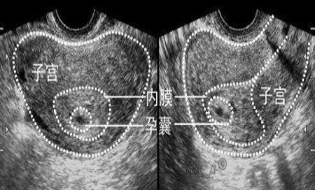 孕囊的区别图图片