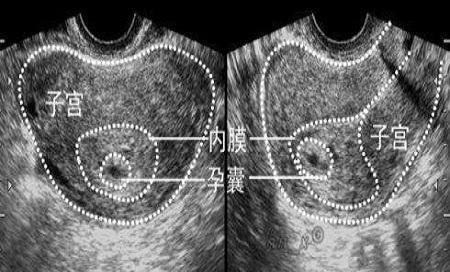 当受精卵植入到子宫内膜后,就会逐渐成长为孕囊,是被羊膜,血管网等
