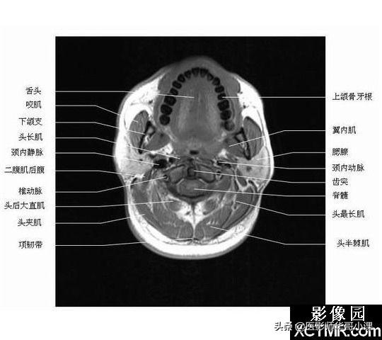 颅脑mri(头部MRI)插图(52)