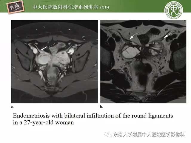 子宫颈影像解剖，子宫详细解剖及磁共振信号分析