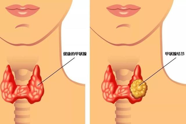 为什么甲癌不算癌，甲状腺癌还能算是癌症吗