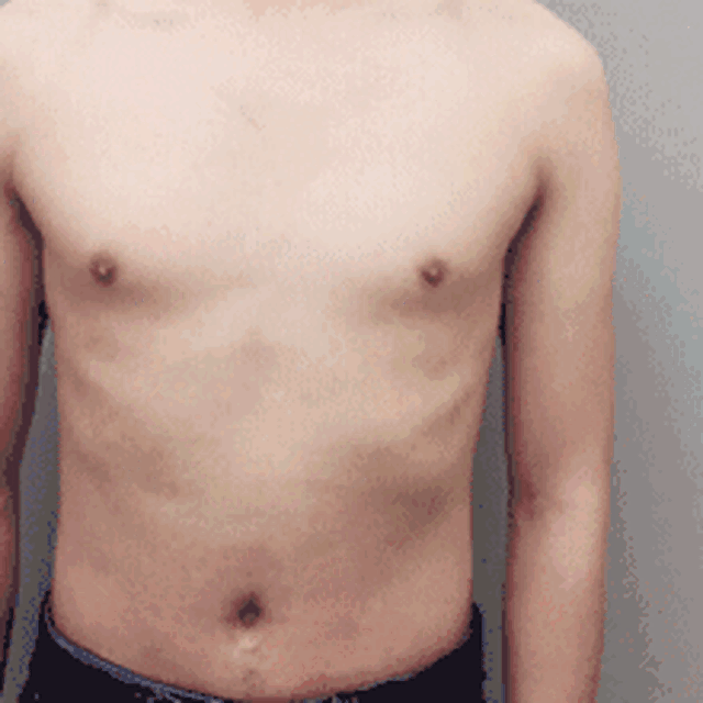 男生胸大怎么减，男生的胸大怎么瘦下来（没想到男性胸大竟然是一种病）