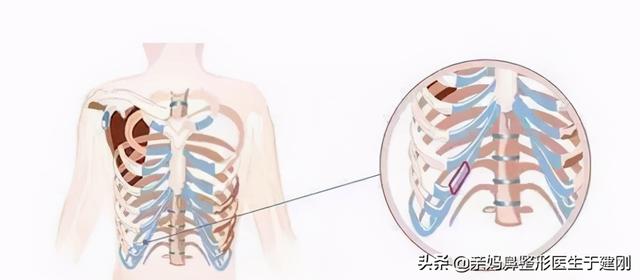 一张图看懂鼻基底凹陷对比图，塌鼻秒变立体质感鼻