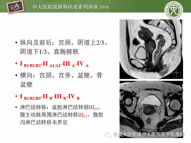 子宫颈影像解剖，子宫详细解剖及磁共振信号分析