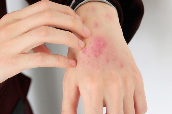 床虱会飞吗,床虱为什么会有(不起眼的虫子会引起皮肤病)