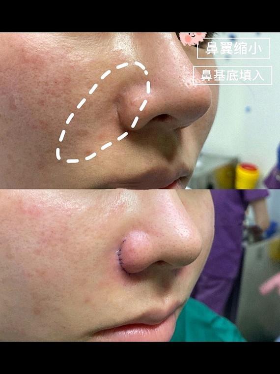 鼻基底填充原理，鼻基底填充的效果（注射填充好还是假体填充好）
