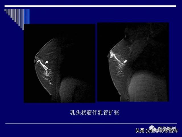 乳房解剖学基础知识，乳腺解剖及乳腺各病变影像诊断与鉴别