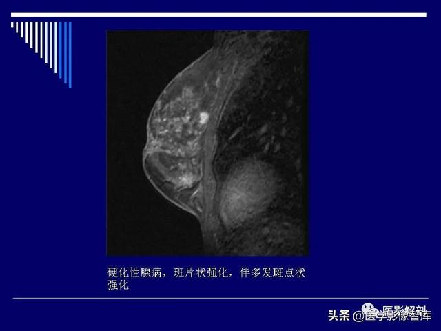 乳房解剖学基础知识，乳腺解剖及乳腺各病变影像诊断与鉴别