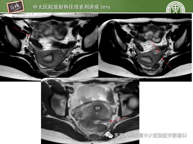 子宫颈影像解剖，子宫详细解剖及磁共振信号分析