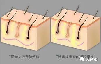 什么是狐臭，什么是狐臭纯合子和杂合子（实不相瞒，这2个都可能是祸根）