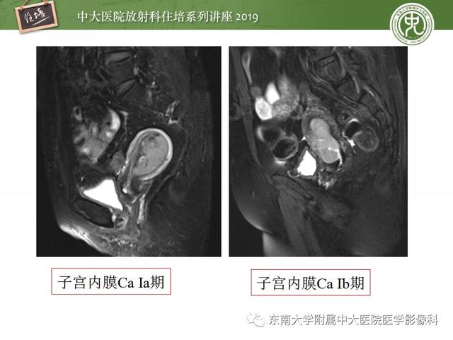 子宫颈影像解剖，子宫详细解剖及磁共振信号分析