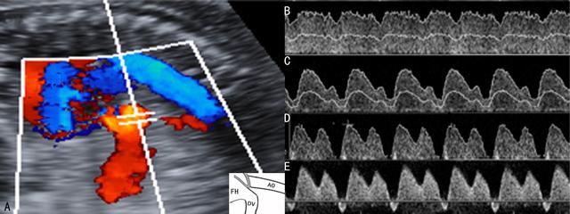 sga是什么意思，毁人之国而非久也的久是什么意思（胎儿超声多普勒检查应用2）