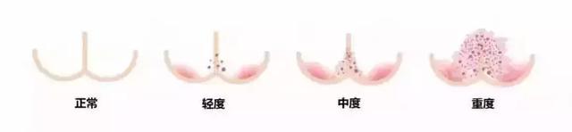 宝宝屁股红怎么办，三个关键词让宝妈不再烦恼